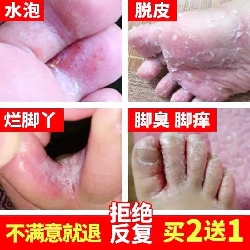 治疗脚癣脚气去根脚痒脱皮杀菌水泡药膏根治止痒真菌感染烂脚丫