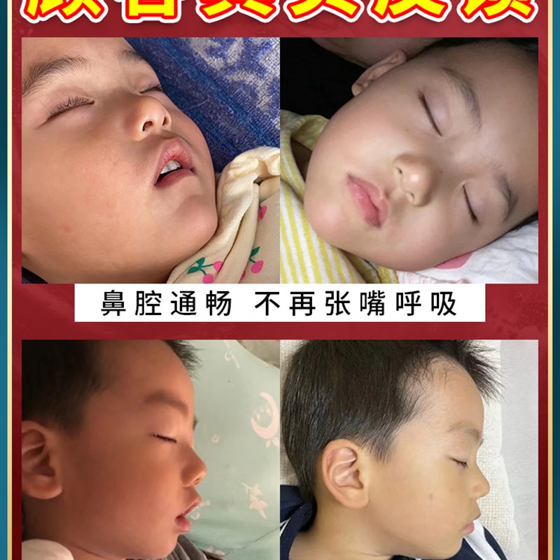 腺样体肥大中药贴儿童宝宝鼻塞睡觉张嘴呼吸不通气打呼噜调理专用
